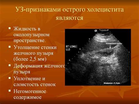 Альтернативные методы лечения изгиба желчного мешка