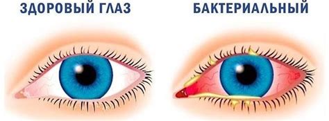 Бактериальный коньюктивит: важность препаратов и правильной терапии