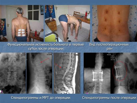 Болевая реакция: обычное сочетание факторов после удаления грыжи между позвонками