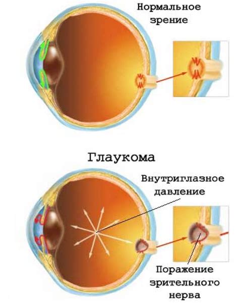 Виды операций при глаукоме