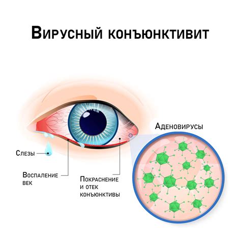 Вирусный конъюнктивит: как отличить и эффективные способы борьбы