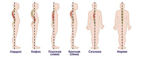 Влияние деформации позвоночника на здоровье мужчин