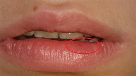 Влияние микротравм на появление разрывов на поверхности губы