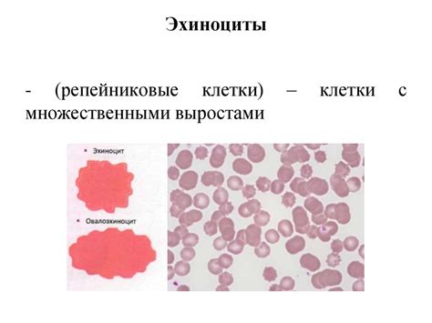 Влияние некоторых заболеваний на уровень эритроцитов малого размера