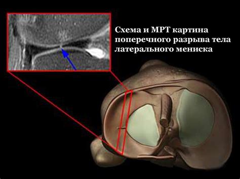 Влияние травматических повреждений задних стебельков внутреннего мениска второго типа Stoller на функциональность коленного сустава