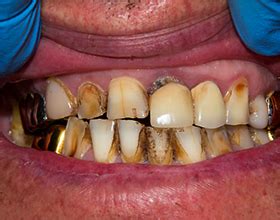 Возможные последствия гнилых зубов