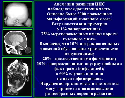 Врожденные аномалии развития мозга