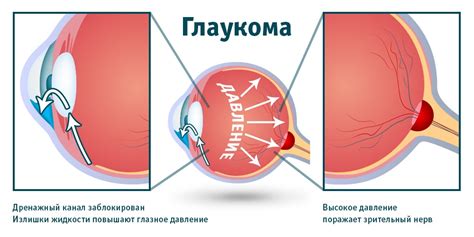 Глаукома: причины, симптомы, лечение