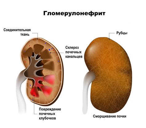 Гломерулонефрит: основные причины, симптомы и лечение