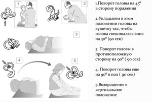 Головокружение при повороте головы