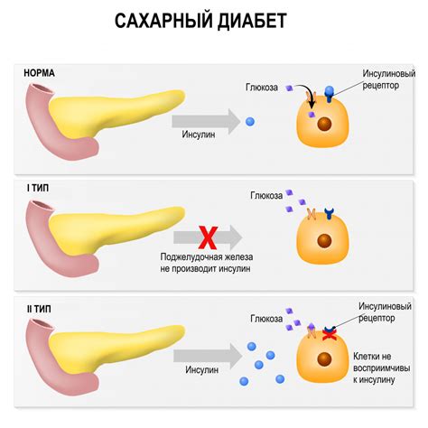 Головокружение при сахарном диабете: риск и причины