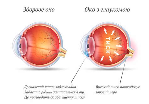 Диагностика глаукомы вторичной