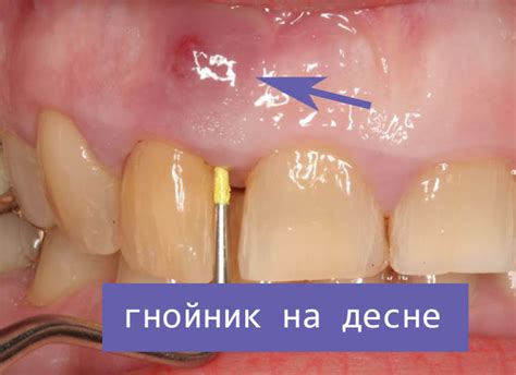 Диагностика гнойного мешка на десне