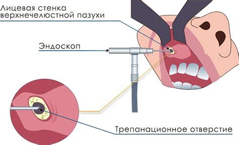 Диагностика гомогенного затемнения гайморовых пазух