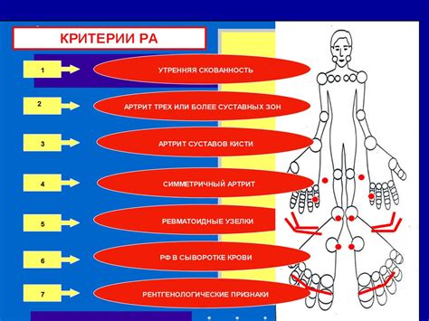 Диагностика и оценка степени острой ревматической атаки