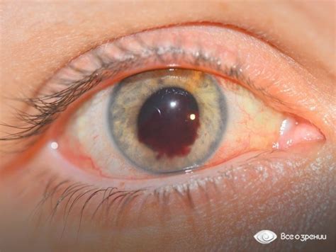 Дополнительные меры для устранения кровоизлияния в глазу