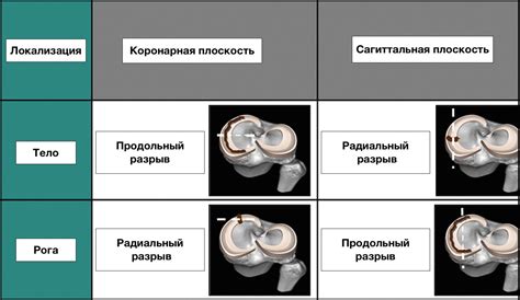 Задний выступ медиального мениска Stoller 2: особенности структуры