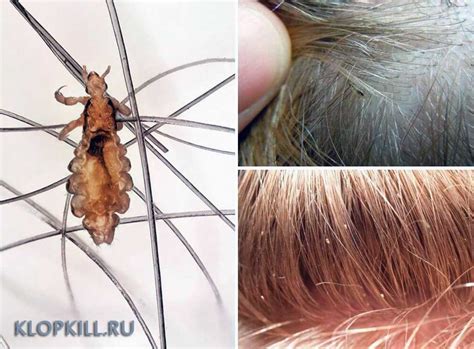 Защита волос: эффективные методы борьбы с гнидами и полезные подсказки