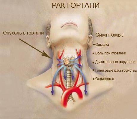 Злокачественные опухоли гортани