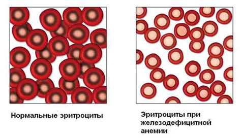 Исследование содержания железа в организме при анемии