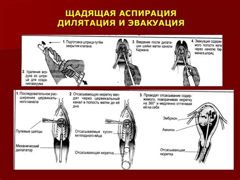 Какие результаты можно ожидать после вакуумной аспирации?