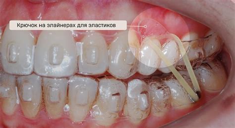 Как Глассин применяется в эндодонтии?