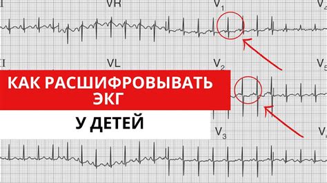 Как обнаружить изменения на ЭКГ у маленького пациента