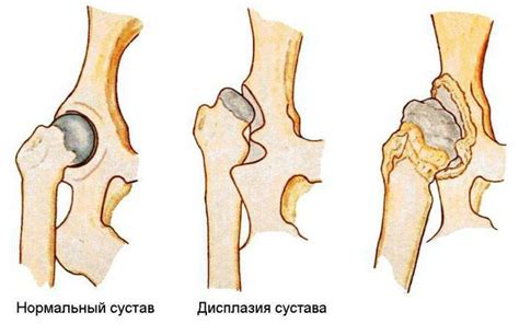 Как распознать наличие утиной походки