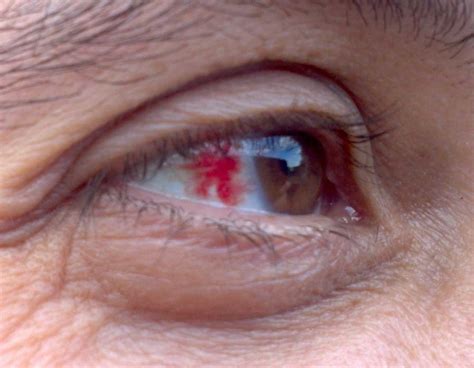 Когда обратиться за медицинской помощью при кровоизлиянии в глаз