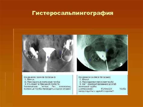 Когда следует выбрать гистеросальпингографию?