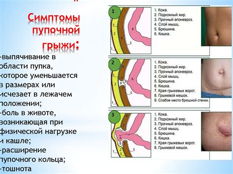 Когда требуется хирургическое вмешательство при гастродуоденальной язве