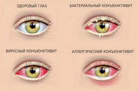 Контактный коньюктивит: особенности и подходы к лечению