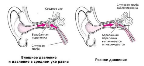 Методика и значимость измерения рефлекса барабанной перепонки тип А