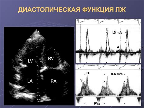 Методы диагностики сохранения глобальной систолической функции лж