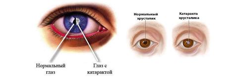 Методы лечения гнойных ниток в глазах