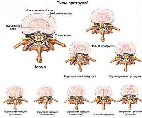 Негативные последствия просроченного отсутствия медицинской помощи при протрузии межпозвоночного диска