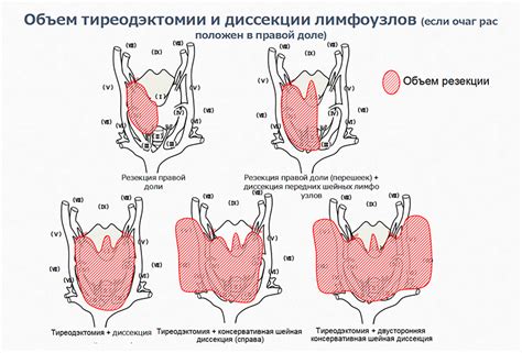 Обнаружение аномалий на щитовидной железе при нормализации гормонального баланса