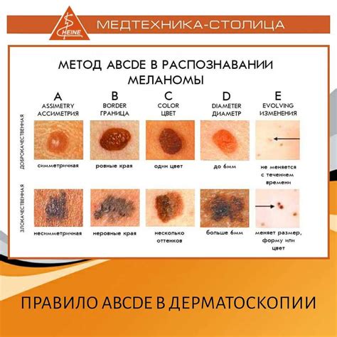 Опасность родинки: когда следует беспокоиться и в каких случаях рекомендуется удаление