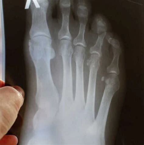 Описание причин возникновения трещины в пальце на ноге
