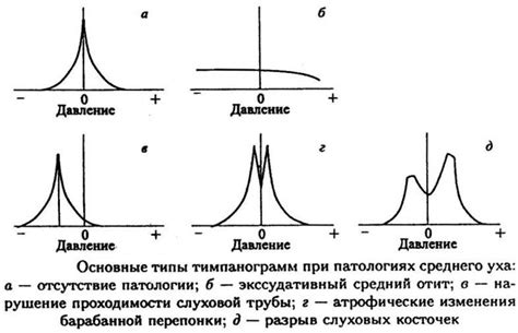 Определение и суть тимпанометрии тип А