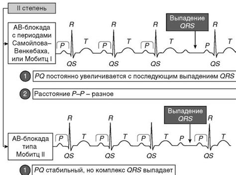 Определение особенности на электрокардиограмме