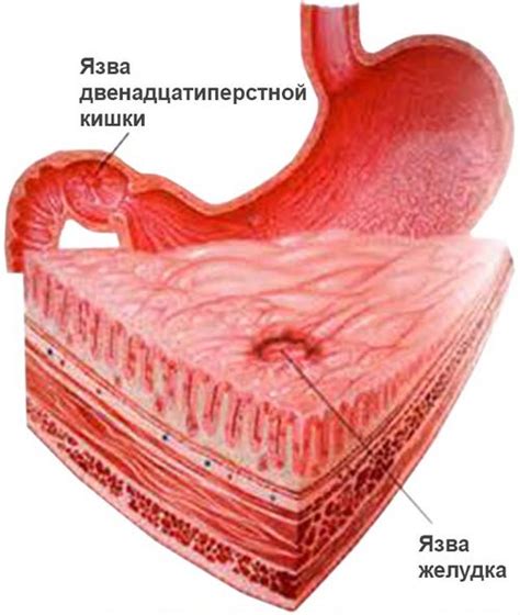 Основные признаки язвы в желудке и двенадцатиперстной кишке