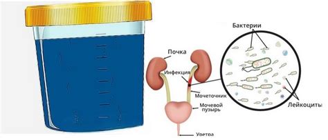 Основные этиологические факторы появления алармующего оттенка мочи у мужчин