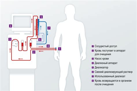 Особенности выбора метода гемодиализа в зависимости от состояния пациента