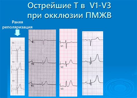 Особенности и нюансы интерпретации отведений V1 V2 V3 на ЭКГ