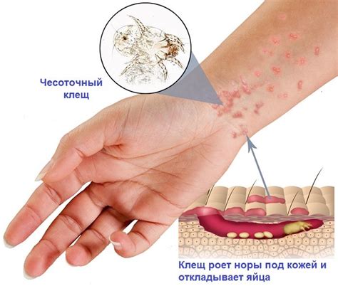 О чесотке: механизм передачи и симптомы