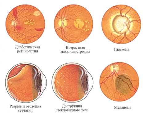 Патологии глазного дна