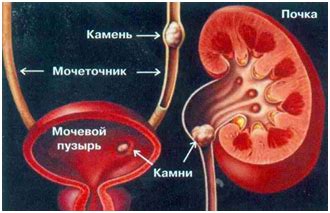 Патологическое образование камней в органах мочевой системы: возможный источник проблемы