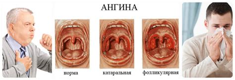 Первичные симптомы гнойной ангины