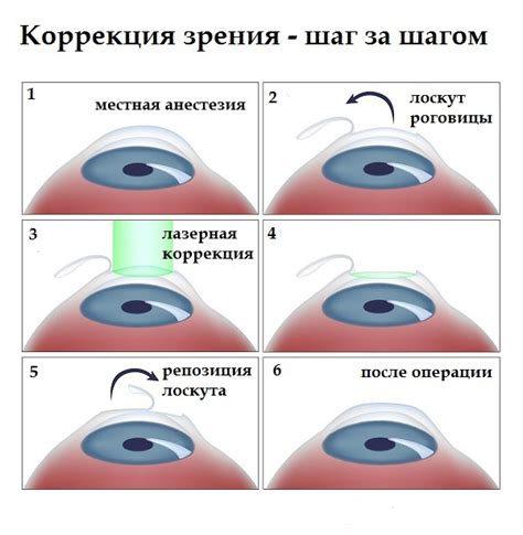 Первое направление: лазерная коррекция зрительной функции